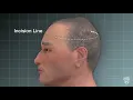 Tony s Story Eliminating a Complex Brain Tumor