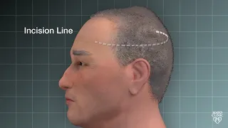 Tony s Story Eliminating a Complex Brain Tumor