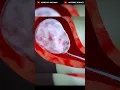 Understanding Abortion: 3D Animation Explaining D\u0026E Procedures | Dilation and Evacuation