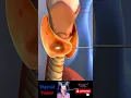 Download Lagu Goiter ※ Thyroid Tumor 💉Radiofrequency Ablation ┬┬ RFA