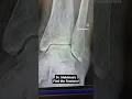 Find the fracture - distal fibula fracture