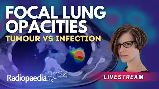Focal lung opacities tumour vs infection with Miranda Siemienowicz