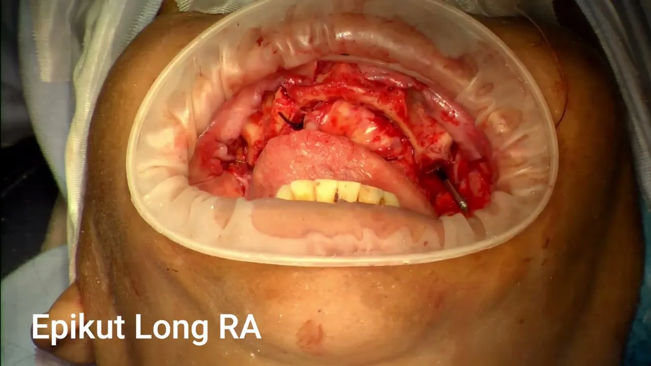 Versalis Surgery at ORCAA