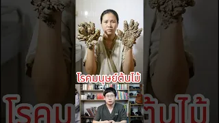 โรคที่ทำให้คนกลายเป็น 'มนุษย์ต้นไม้' คือโรคอะไร และเกิดจากสาเหตุใด