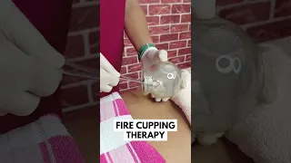 CUPPING THERAPY