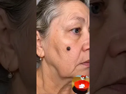 Best Tips for Skin Tags or Warts Problem #shorts #skincare #beauty #beautytips #homeremedies
