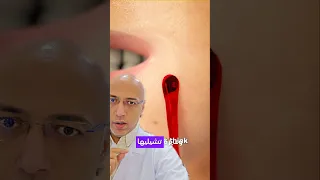 ازاي تتخلصي من الشامه في البشره  الشامة  البشرة  العناية بالبشرة  الاثاليل  الزوائد الجلدية  الشامات دندنها
