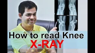 Learn to read X-ray Online Meaning Of X ray HINDI Knee x ray reading Knee Osteoarthritis X ray