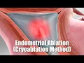 Endometrial Ablation Cryoablation Method