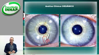 1 Iridologia orgânica - aula analisando a íris na prática.