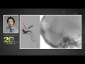 Download Lagu Venous Compression Syndromes: From Diagnosis to Treatment