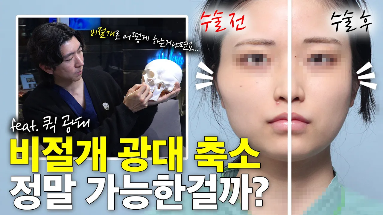 비절개 광대축소술, 정말 가능한가요? 😮 👉🏻성형외과 전문의가 솔직히 알려드립니다👈🏻