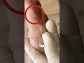 What is a Callus