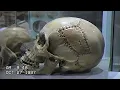 Evidence Of Advanced Surgery Found On Ancient Human Remains