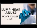 Is That Lump Near Your Anus Serious Don t Ignore These Signs