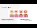 ICD-10-CM Coding for Skin Ulcer-L Codes - MEDESUN Academy