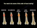 How Does Broken Bone Heal