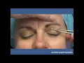 Download Lagu Tutorial - Marking the Upper Lid Blepharoplasty