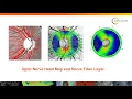 OCT Interpretation in the Diagnosis and Management of Glaucoma