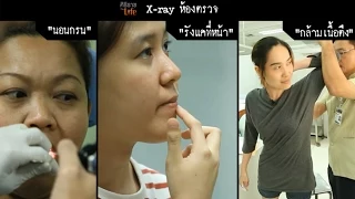 สาเหตุหลักที่ทำให้เกิดอาการนอนกรนและหยุดหายใจขณะหลับคืออะไร