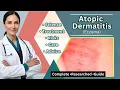 Atopic Dermatitis Eczema Guide Causes Triggers Treatments How to Stop itch