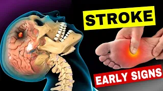8 Warning Signs of Stroke One Month Before 9 Powerful Tips to Prevent It
