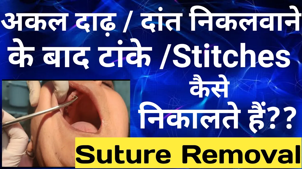 अकल दाढ़/दांत निकलवाने के बाद टांके कैसे निकालते हैं? |Stitch Removal On Patient #youtubeshorts