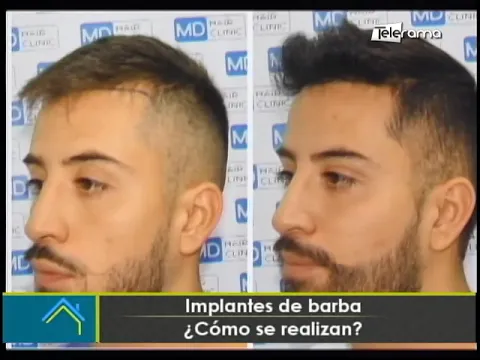 Implantes de barba ¿Cómo se realizan?