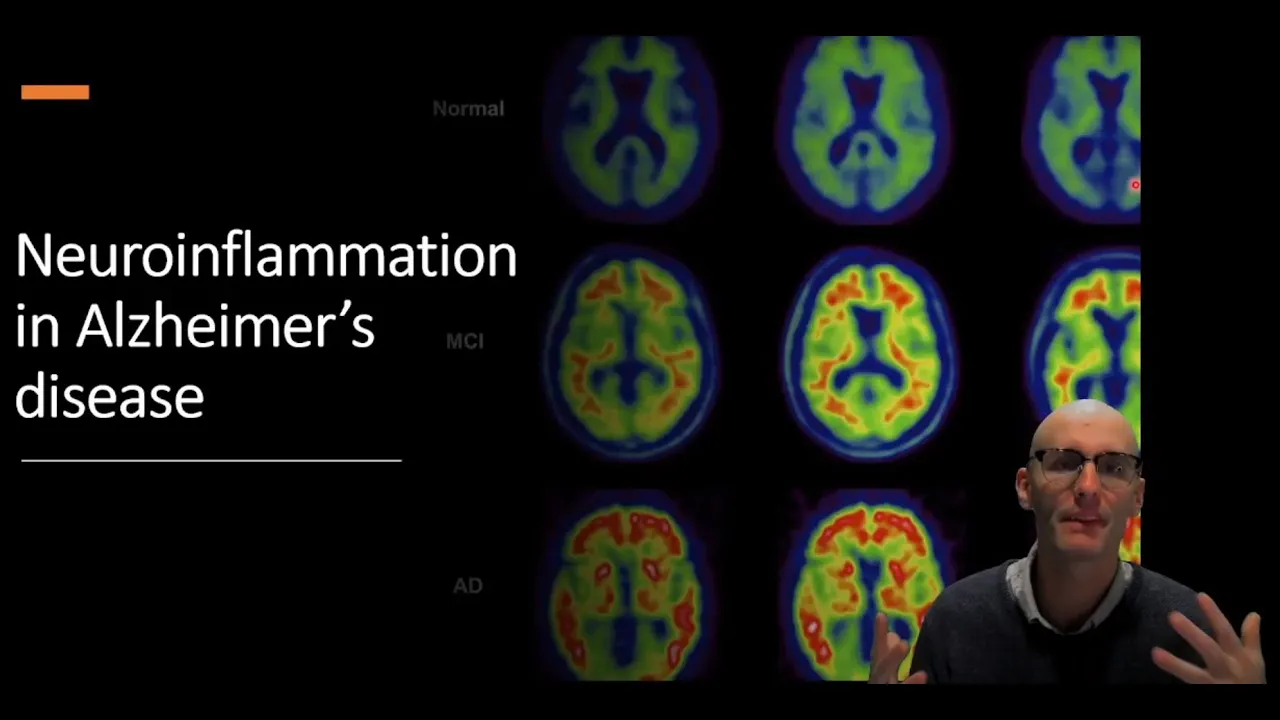 Neuroinflammation in Alzheimer's Disease: The Role of Microglia