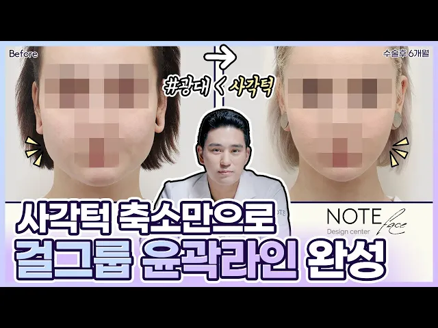 [유.케.리] 📍 CT로 보는 케이스 리뷰 l 사각턱+앞턱 l 핀리스브이라인+피질절골술