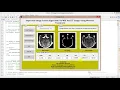 Image Fusion On MRI and CT Image Using Matlab Project Code