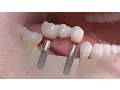 Download Lagu Straumann - Implantaatbehandeling bij meerdere ontbrekende tanden