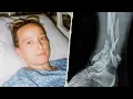 I Nearly Lost My Leg In a Rock Climbing Accident