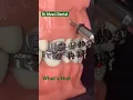 Dental Braces Orthodontics teeth alignment