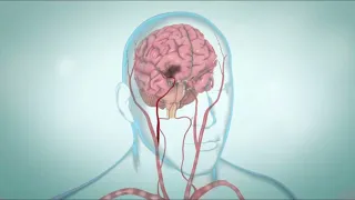 Ischemic Stroke: A Comprehensive Guide to Signs, types, and Treatment