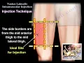 Vastus Lateralis Intramuscular Injection - Everything You Need To Know