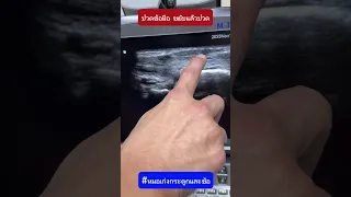  ทำไมมือถึงบวมและเจ็บเวลาบิดข้อมือหลังให้นมลูก 2 เดือน 