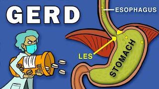 Gastroesophageal Reflux Disease GERD