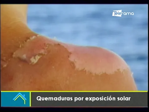 Quemaduras por exposición solar