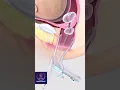 Download Lagu Cervical Dilation \u0026 Curettage - Cervix Opening with Balloon #shorts