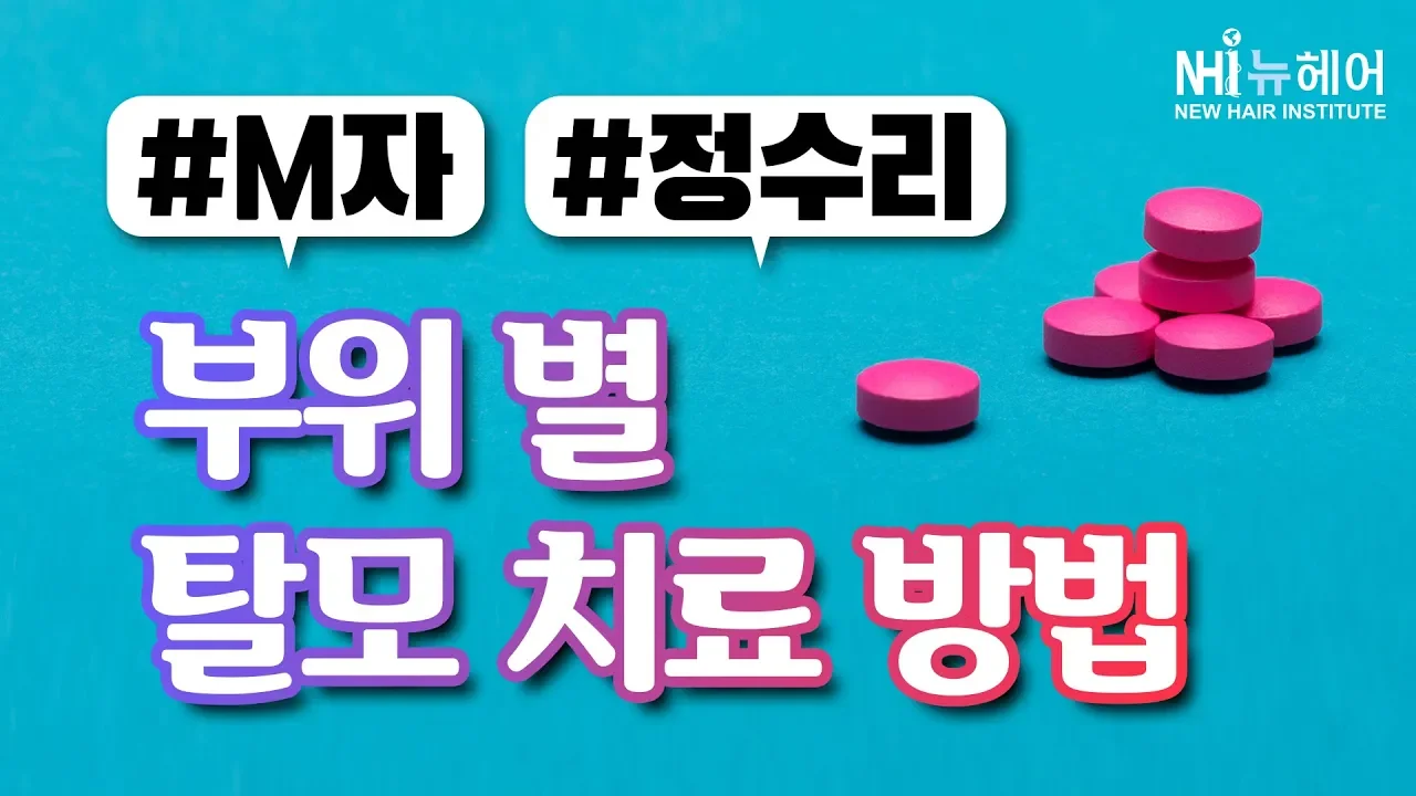 M자탈모(앞머리탈모)와 정수리탈모! 각각의 탈모치료 방법은? - 뉴헤어 I 모발이식 I 탈모QnA I