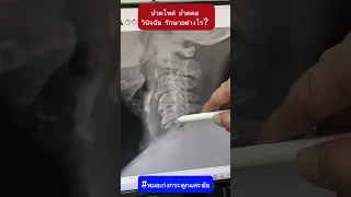  อาการปวดไหล่ข้างขวาที่มีการจำกัดการเคลื่อนไหวและเจ็บในข้อไหล่ เกิดจากสาเหตุอะไรบ้าง 