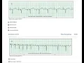 Relias Dysrhythmia Basic A Real Test Correct Questions Answers