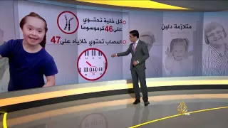 ما هي متلازمة داون 