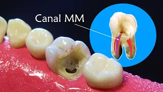 Overlooking this hidden canal can lead to root canal treatment failure.