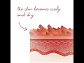 Custom Medication for Ichthyosis