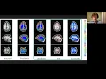 Applications of deep learning in neuroimaging Nobrainer