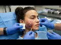 Infected Sebaceous Cyst Removal Epidermal Cysts extractions Cyst popping this week