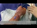 Download Lagu How to use ZEPHYR™ Vascular Compression Band for distal radial