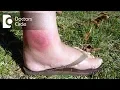 How to manage spider bite with swelling redness - Dr Nischal K